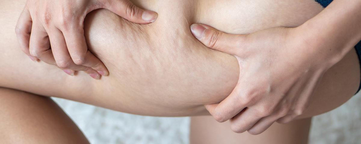 Why the body has Cellulite build up