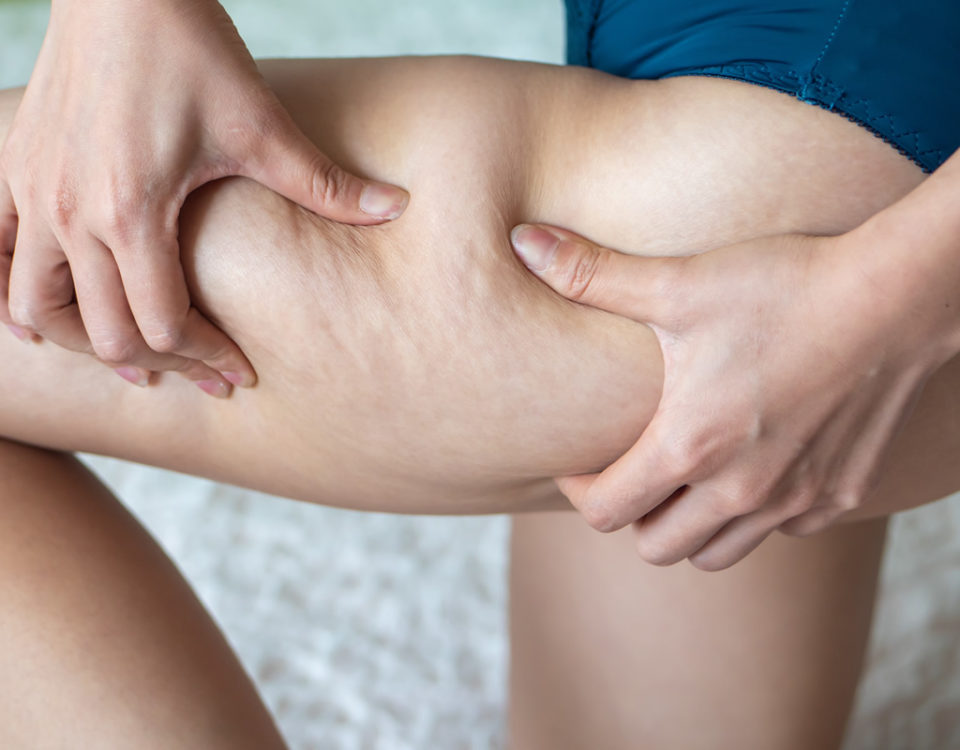 Why the body has Cellulite build up